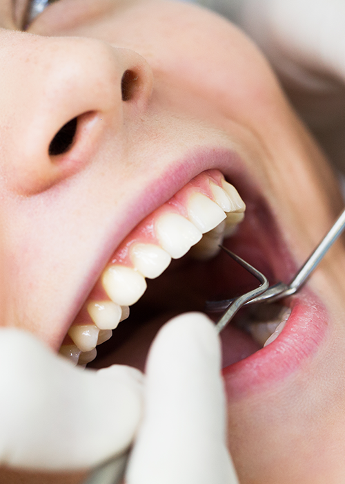 Close-up of a dentist working inside a patient's mouth.